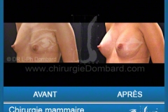 <h2>Chirurgie esthétique des seins - Lifting des seins: Varia.</h2> Chirurgie esthétique des seins - Lifting des seins - chirurgie mammaire