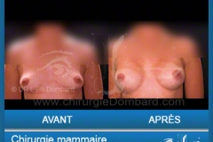 Chirurgie esthétique des seins - Lifting des seins - chirurgie mammaire