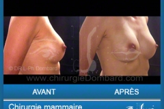 Chirurgie esthétique des seins - Lifting des seins - chirurgie mammaire