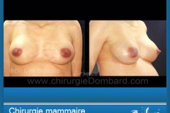 Examen de routine: Femme enceinte avec implants
