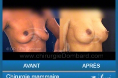 Chirurgie esthétique des seins - Lifting des seins - chirurgie mammaire