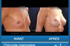 Chirurgie esthétique des seins - Lifting des seins - chirurgie mammaire