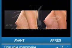 <h2>Chirurgie esthétique des seins - Lifting des seins: Varia.</h2> Chirurgie esthétique des seins - Lifting des seins - chirurgie mammaire