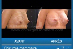 <h2>Chirurgie esthétique des seins - Lifting des seins: Varia.</h2> Chirurgie esthétique des seins - Lifting des seins - chirurgie mammaire