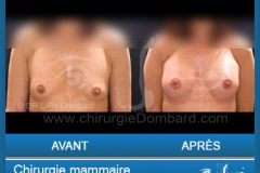 <h2>Chirurgie esthétique des seins - Lifting des seins: Varia.</h2> Chirurgie esthétique des seins - Lifting des seins - chirurgie mammaire