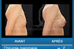 Prothèse ronde rétro-musculaire