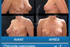 Chirurgie esthétique des seins - Lifting des seins - chirurgie mammaire