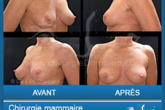 <h2>Chirurgie esthétique des seins - Lifting des seins: Varia.</h2> Chirurgie esthétique des seins - Lifting des seins - chirurgie mammaire