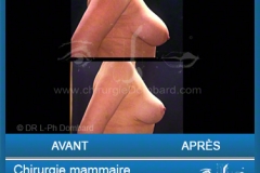 Chirurgie esthétique des seins - Lifting des seins - chirurgie mammaire