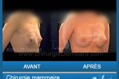Chirurgie esthétique des seins - Lifting des seins - chirurgie mammaire