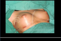 Incision axilaire + Contre-incision au niveau du sillon A