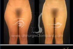 liposculpture culotte de cheval.