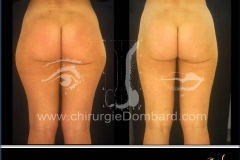 liposculpture culotte de cheval.