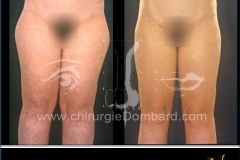 Culotte de cheval et face antérieure des cuisses vue de face
