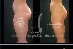 Culotte de cheval et face antérieure des cuisses vue de profil