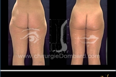 liposculpture culotte de cheval.