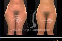 liposculpture culotte de cheval.