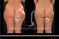 liposculpture culotte de cheval.