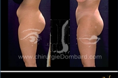 liposculpture ventre et réduction volume des fesses