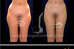 liposculpture culotte de cheval.