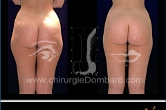 liposculpture culotte de cheval.