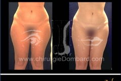 liposculpture culotte de cheval.
