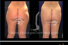 liposculpture culotte de cheval.