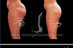 liposculpture réduction volume des fesses et culotte de cheval