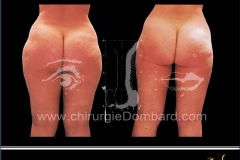 liposculpture réduction volume des fesses et culotte de cheval.