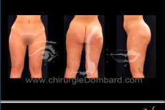 liposculpture réduction volume des fesses et culotte de cheval.