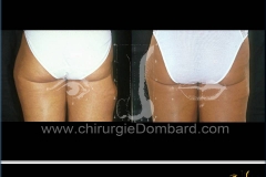 Lipofilling correction cicatrice