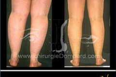 Liposculpture genoux, mollets, chevilles. Résultat 6 mois.