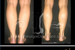 Liposculpture chevilles, mollets, perte de poids.