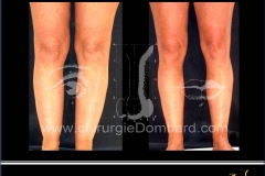 Liposculpture genoux, mollets, chevilles