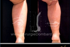 Liposculpture mollets, chevilles. Patient plus de 60 ans.