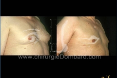 liposuccion liposculpture
