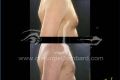liposuccion liposculpture