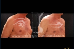 liposuccion liposculpture