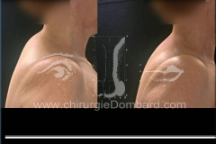 liposuccion liposculpture