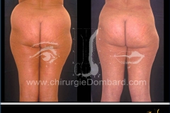 liposuccion liposculpture