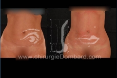 liposuccion liposculpture