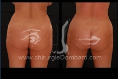 liposuccion liposculpture