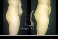 liposuccion liposculpture