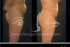 liposuccion liposculpture