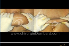 liposuccion liposculpture