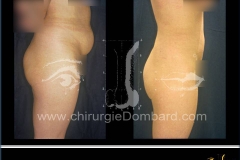 liposuccion liposculpture