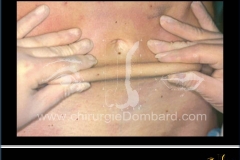 liposuccion liposculpture