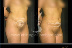 liposuccion liposculpture