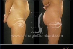 liposuccion liposculpture