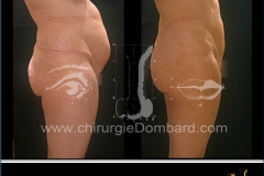 liposuccion liposculpture